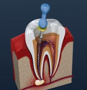 best root canal treatment retreatment in santa ana ca