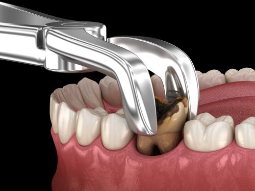 damage caused by infection or decay can make a tooth beyond repair damage caused by infection or decay can make a tooth beyond repair
