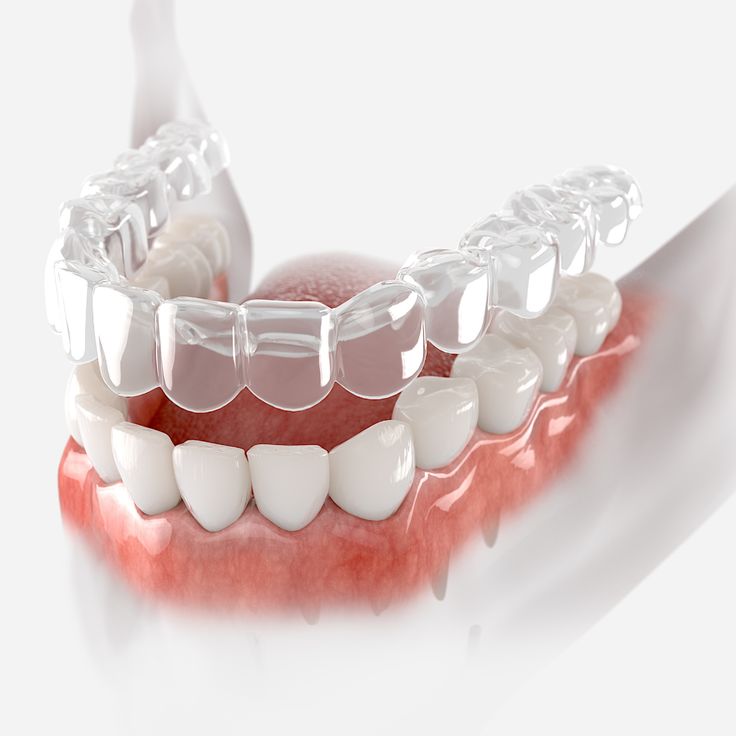 Kukatpally Dental Clinic - clear aligners