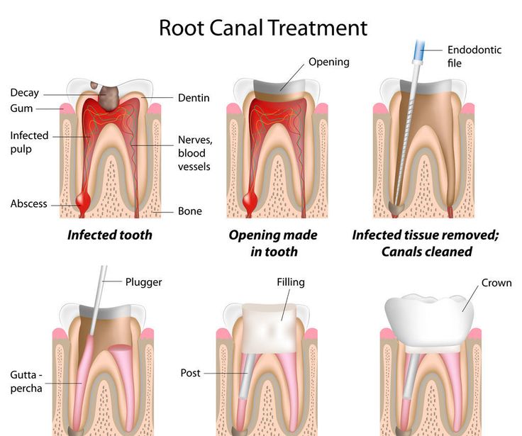 root canal treatment procedure step by step (1) Root Canal Treatment in Kukatpally – root canal treatment procedure step by step (1)