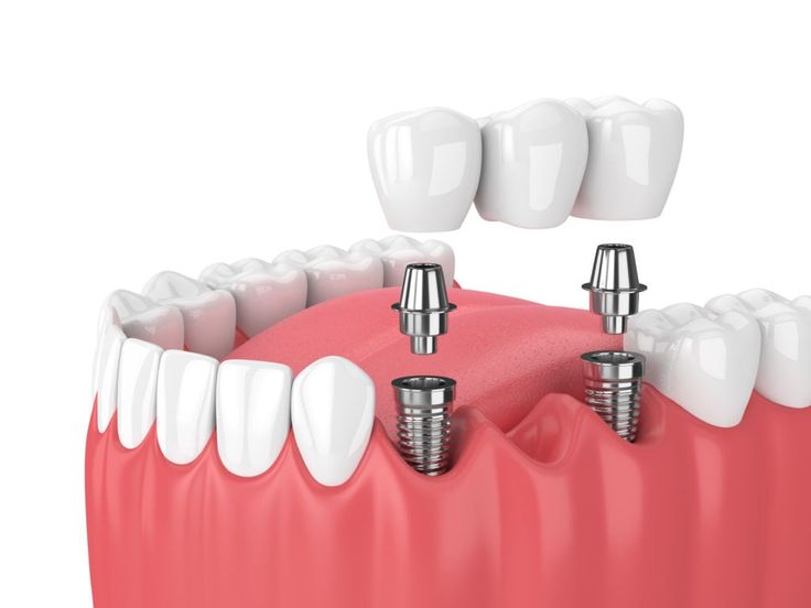kphb dental clinic - dental crown and bridges