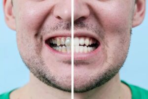 Root Canal Treatment in Kukatpally – what to expect before and after your root canal procedure
