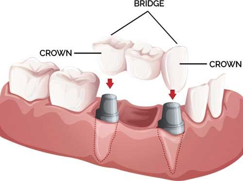 Dental Bridges And Crowns treatment -benifits