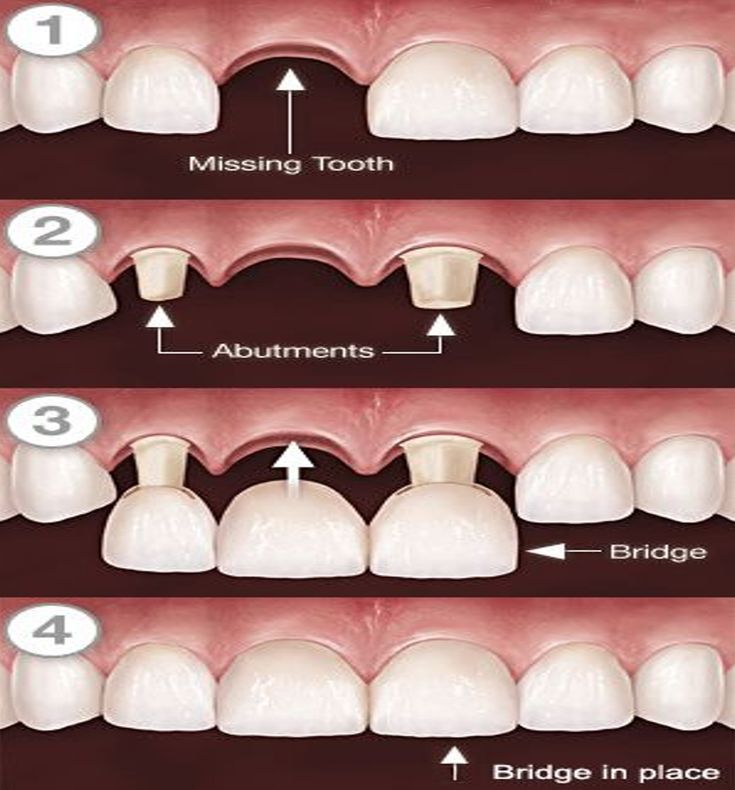 Dental Crowns & Bridges treatment in kukatpally -price