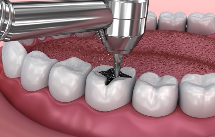 Dental Filling Treatment -signs
