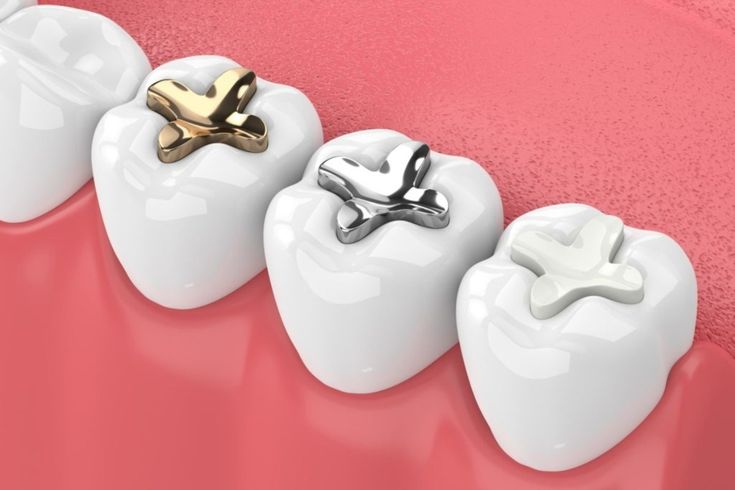 Dental Filling Treatment -types