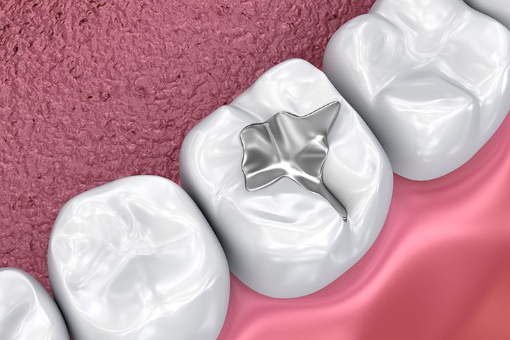 Dental Filling Treatment -materials