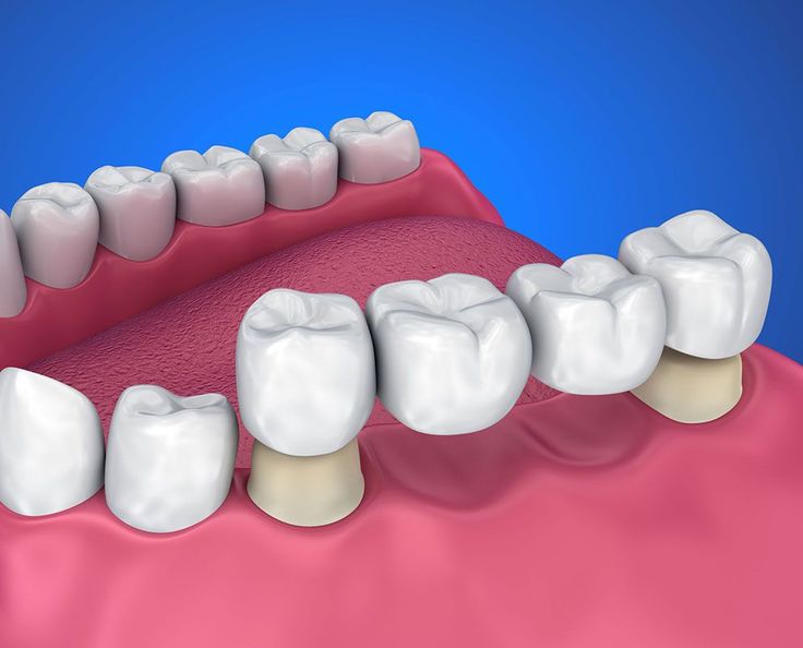 Dental Crowns and Bridges -signs you need treatment