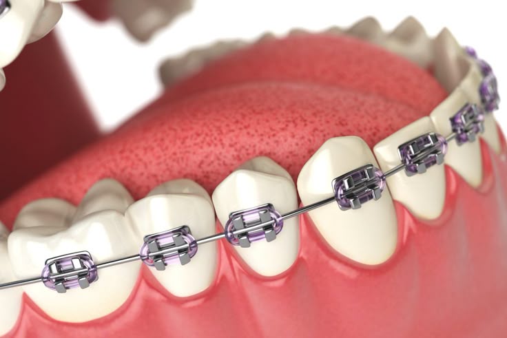 Orthodontics Dental Braces Treatment in Kukatpally-braces