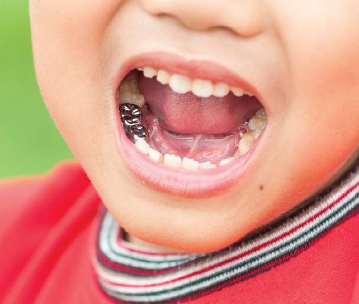 Dental Crowns & Bridges treatment in kukatpally - we offer