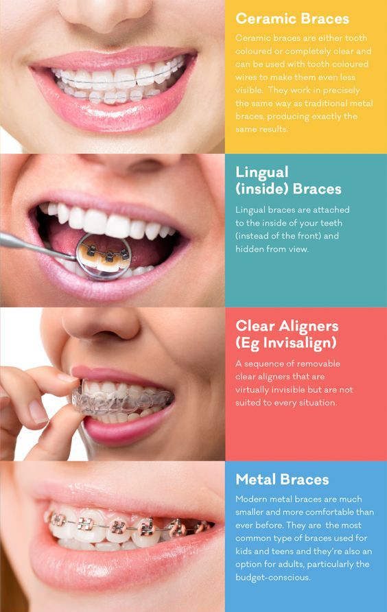 Types of dental braces – Metal, Ceramic, Invisible aligners in Hyderabad-