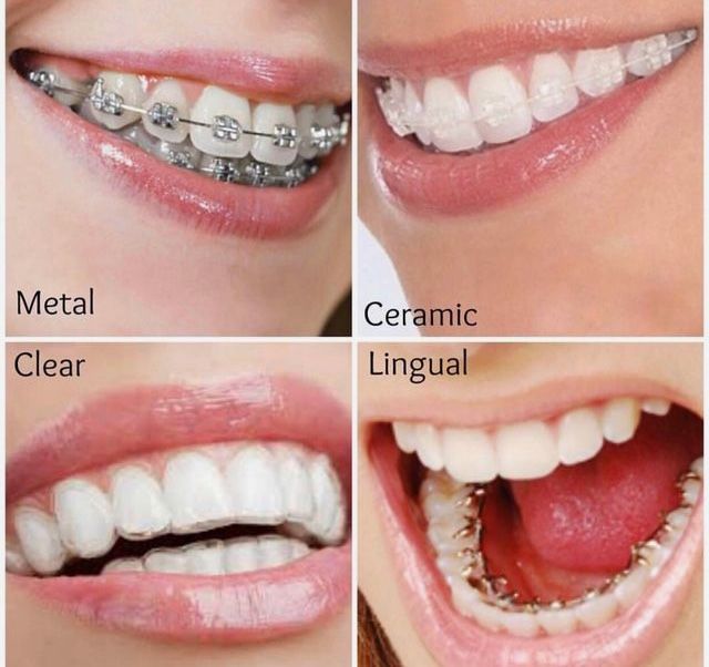 Dentist fixing metal braces in Kukatpally – Expert orthodontist- why chose